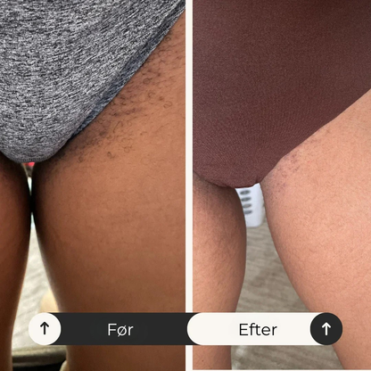 VagiClin™ | Stopper intim kløe og irritation hos 95% af kvinder inden for 72 timer