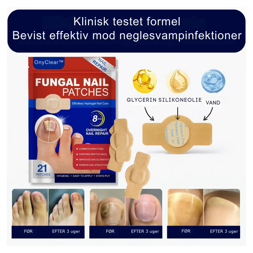 OnyClear™ Therapy Patch - Avanceret pleje for klare og sunde negle.