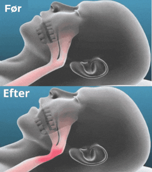 Respiron™ | Bideskinne